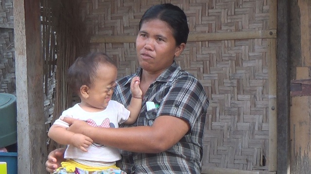 Anggraini Bayi di Jembrana Ini Alami Kelainan Tempurung Kepala